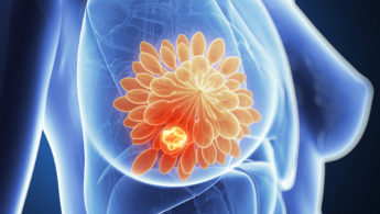 Ερευνητές ανακάλυψαν πώς μπορούν να «φρενάρουν» τις μεταστάσεις στον καρκίνο του μαστού
