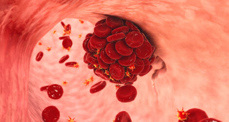 Στέλλα Κοκόρη: Θρομβοφιλία: η σημασία της στο γενικό πληθυσμό